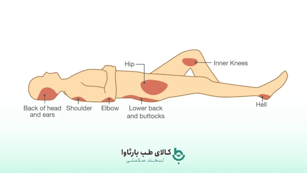 نقاط تحت فشار در زخم بستر