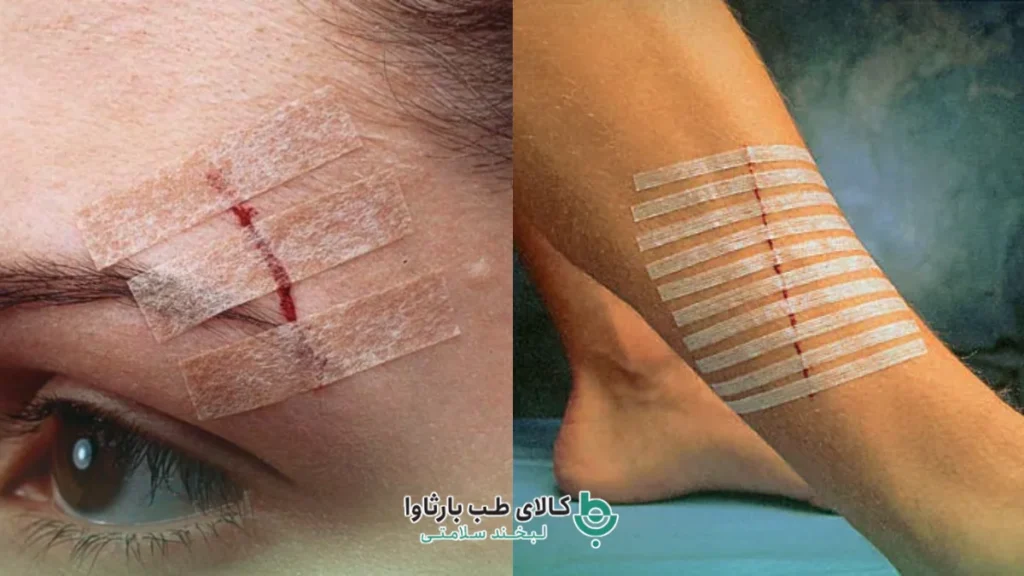 نوار استری استرپ ( Steri-Strip) برای درمان زخم نوین