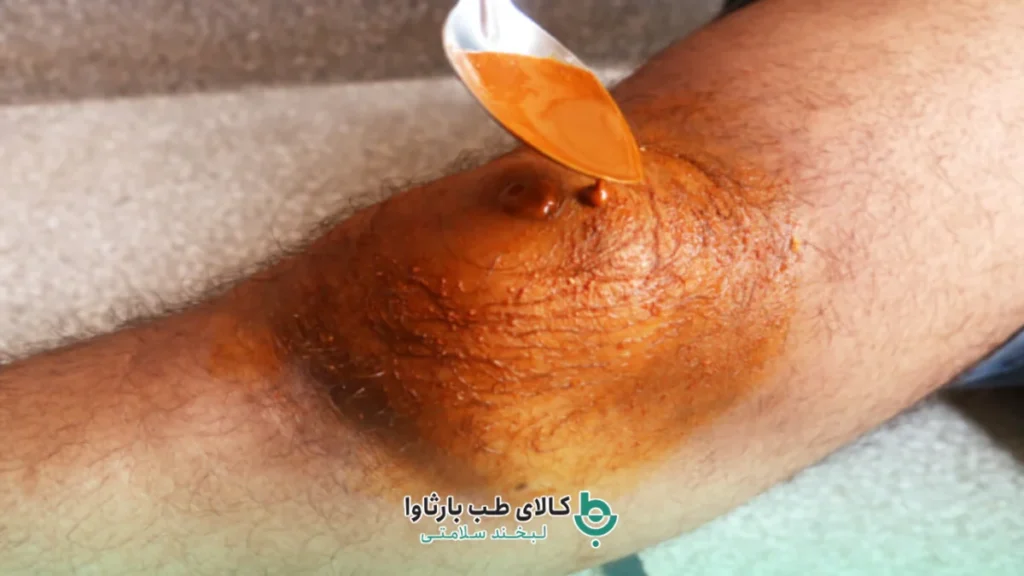 استفاده از زردچوبه برای درمان زخم سنتی