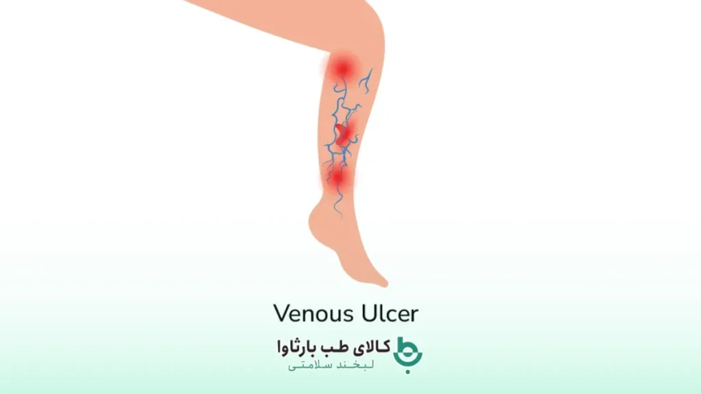 زخم وریدی یا Venous Ulcer چیست