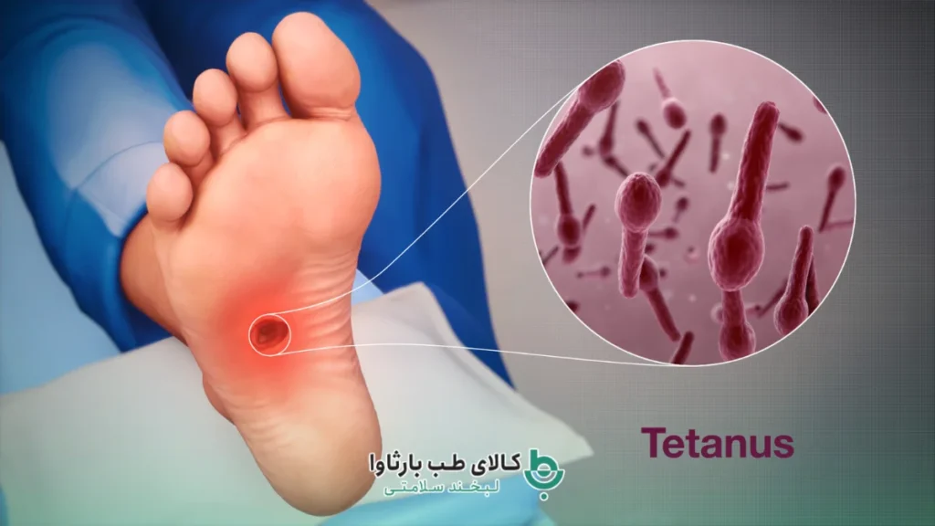 وضعیت کزاز در رویه درمان زخم